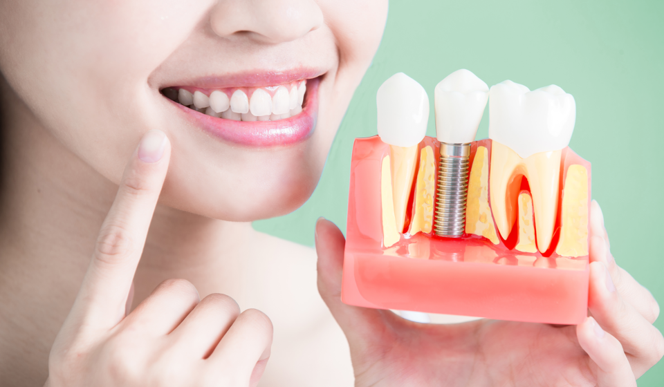 dental implants Replace Your Missing Teeth With Dental Implants Lake of the pines dental dentist in Auburn California